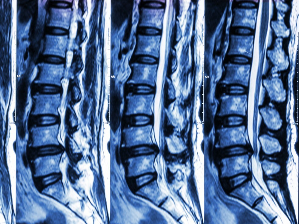 MRI of Lumbar Spine